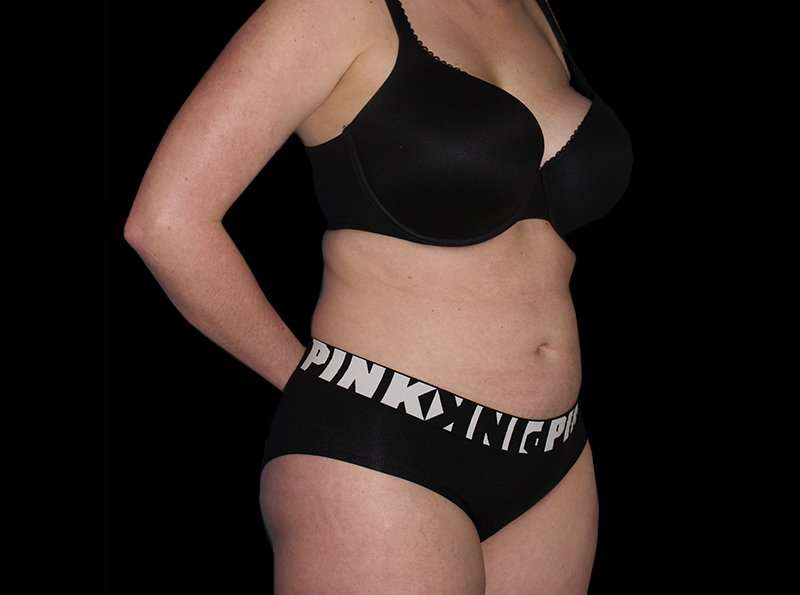 Liposuction Before & After Patient #1298