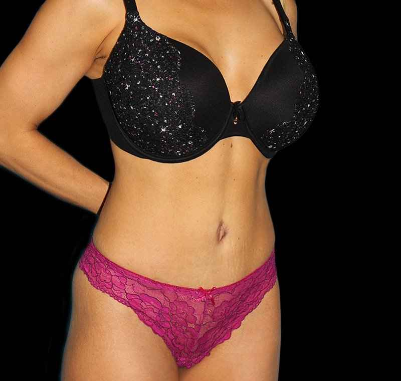 Liposuction Before & After Patient #1310