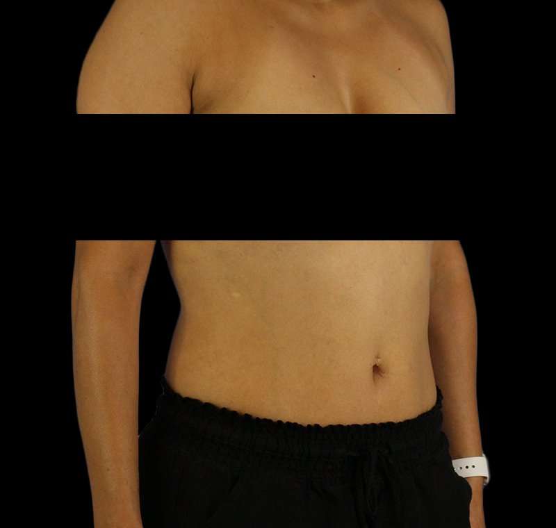 Liposuction Before & After Patient #1332