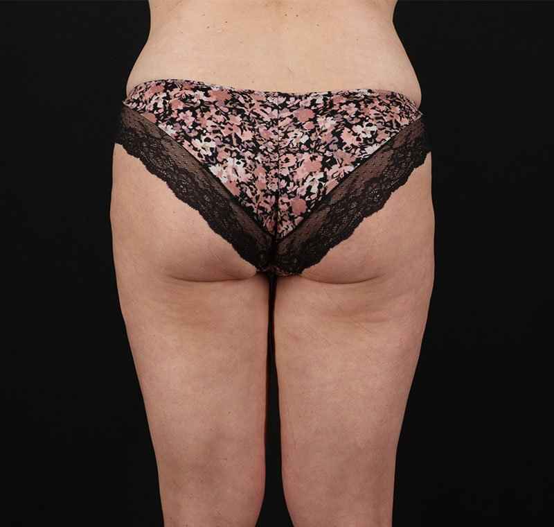 Liposuction Before & After Patient #1337