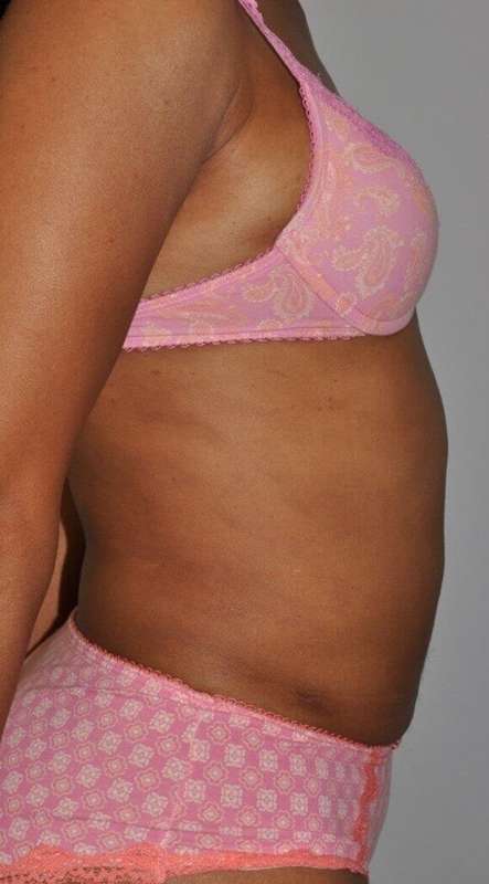 Liposuction Before & After Patient #1425