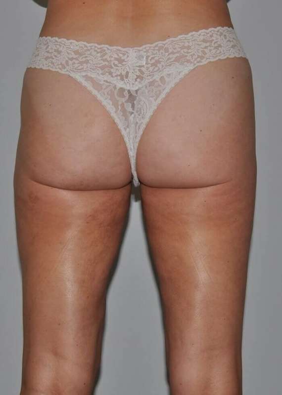 Liposuction Before & After Patient #1433