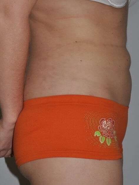 Liposuction Before & After Patient #1439