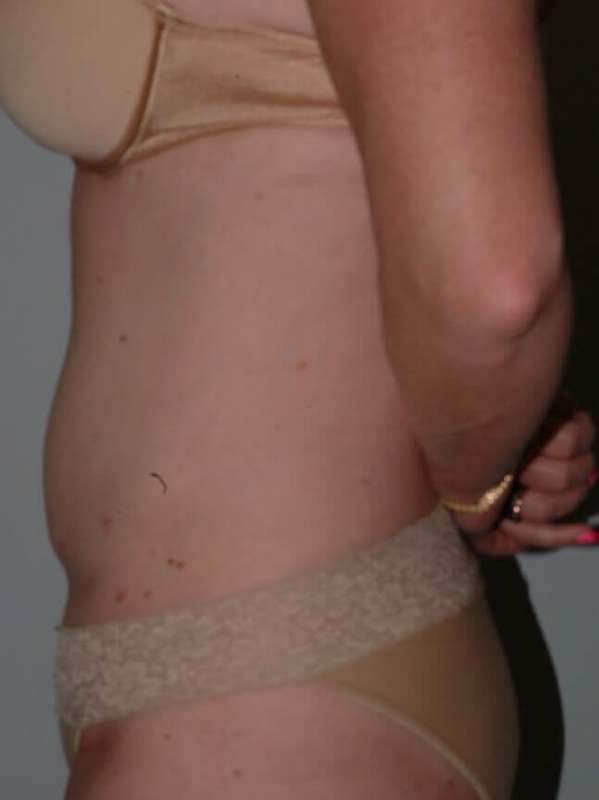 Liposuction Before & After Patient #1445