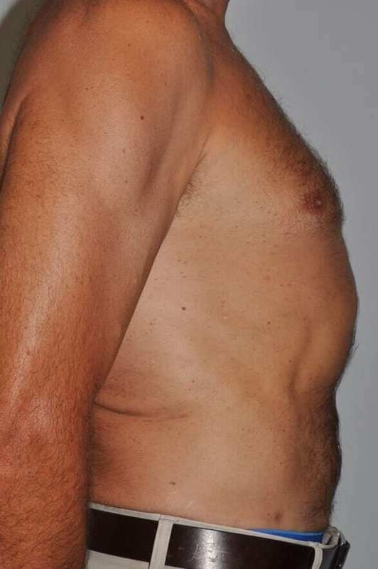 Liposuction Before & After Patient #1450