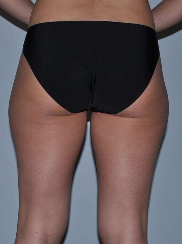 Liposuction Before & After Patient #1455