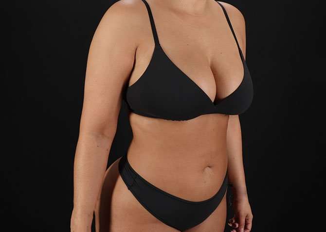 Liposuction Before & After Patient #1469