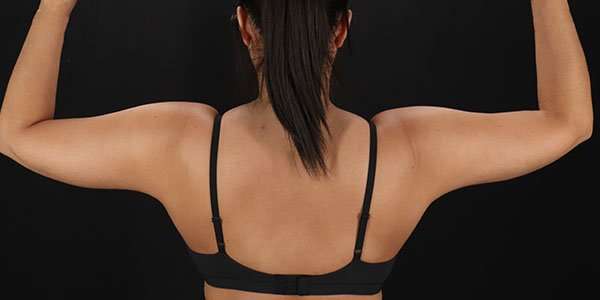 Liposuction Before & After Patient #1482