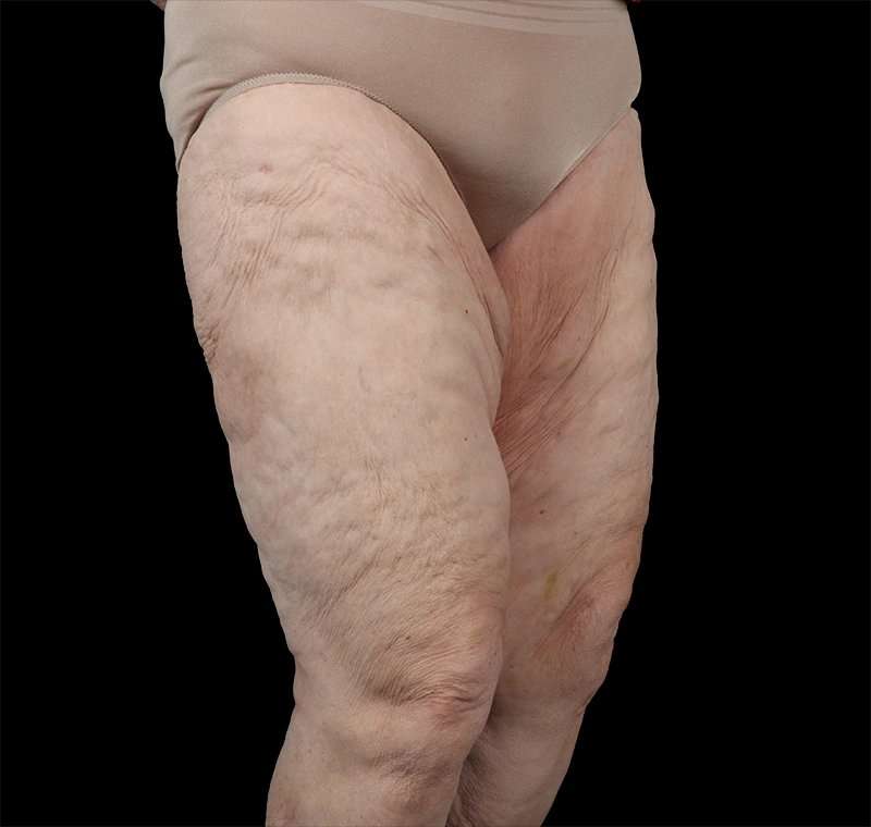 Liposuction Before & After Patient #1495
