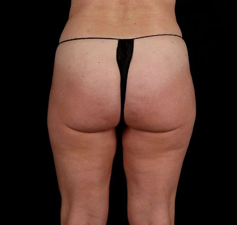 Liposuction Before & After Patient #1500