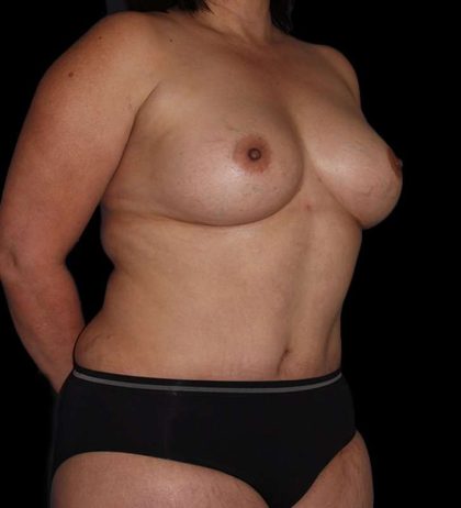 Mommy Makeover Before & After Patient #1547