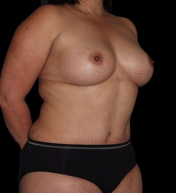 Mommy Makeover Before & After Patient #1547