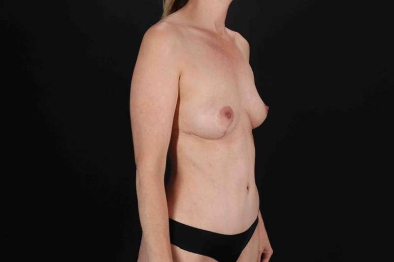 Mommy Makeover Before & After Patient #1610