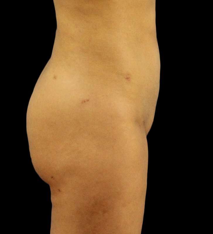 Brazilian Butt Lift Before & After Patient #557