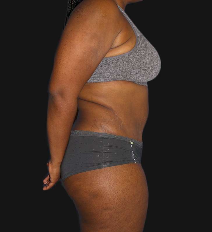 Abdominoplasty (Tummy Tuck) Before & After Patient #568