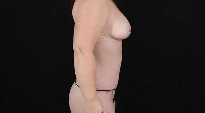 Abdominoplasty (Tummy Tuck) Before & After Patient #693