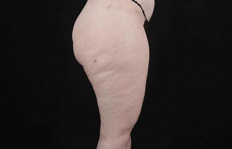 Thigh Lift Before & After Patient #1925