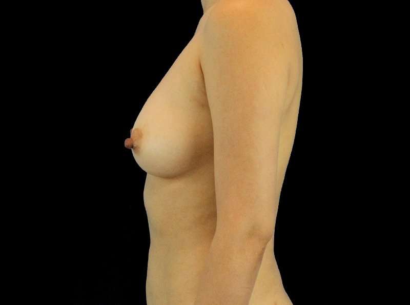 Breast Augmentation w/ Fat Transfer Before & After Patient #1971