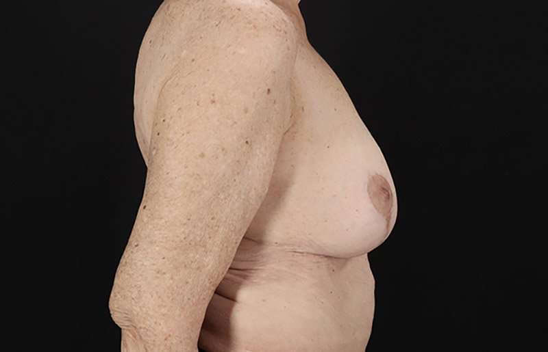 Breast Augmentation w/ Fat Transfer Before & After Patient #2049