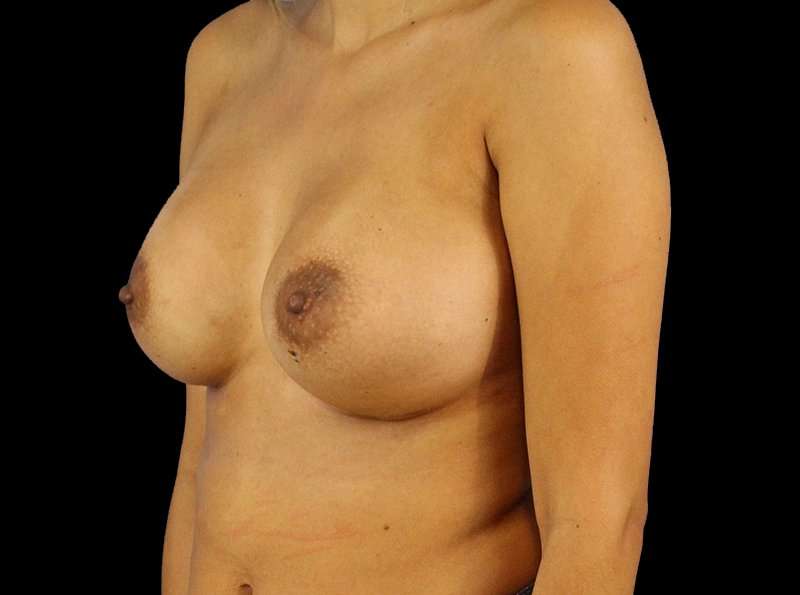 Breast Augmentation Before & After Patient #2129