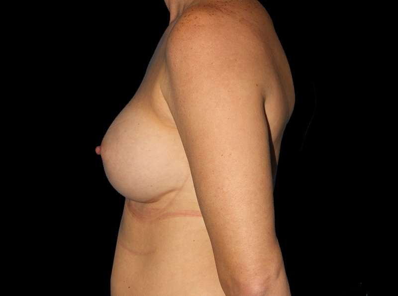 Breast Augmentation Before & After Patient #2136