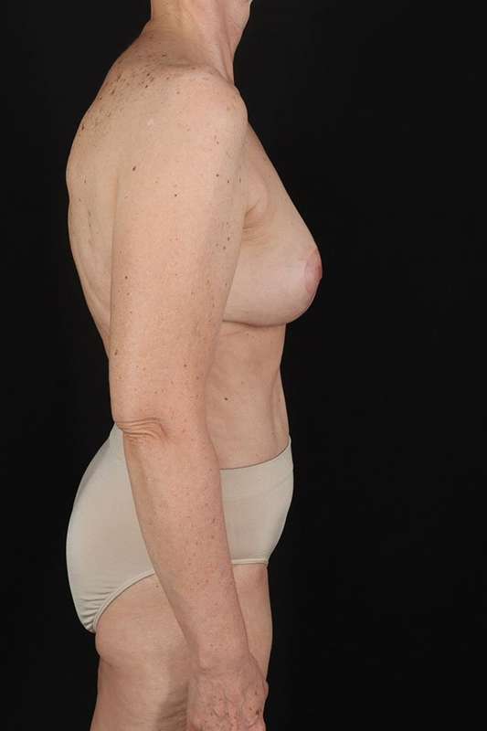 Breast Augmentation Before & After Patient #2263