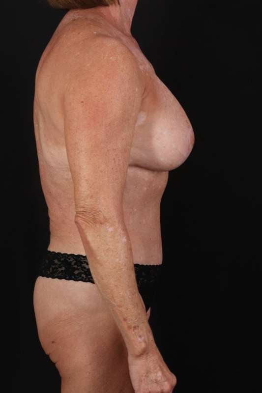 Breast Augmentation Before & After Patient #2270