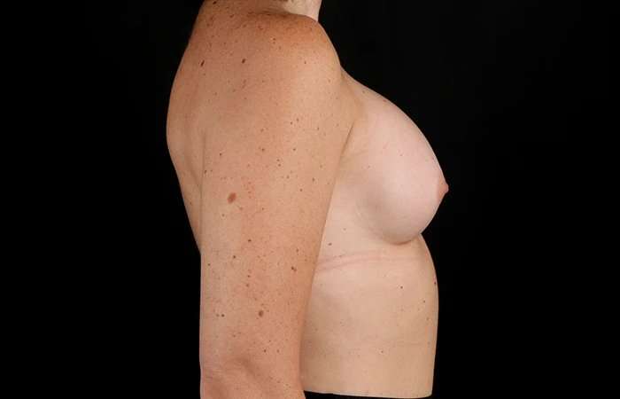 Breast Augmentation Before & After Patient #2365