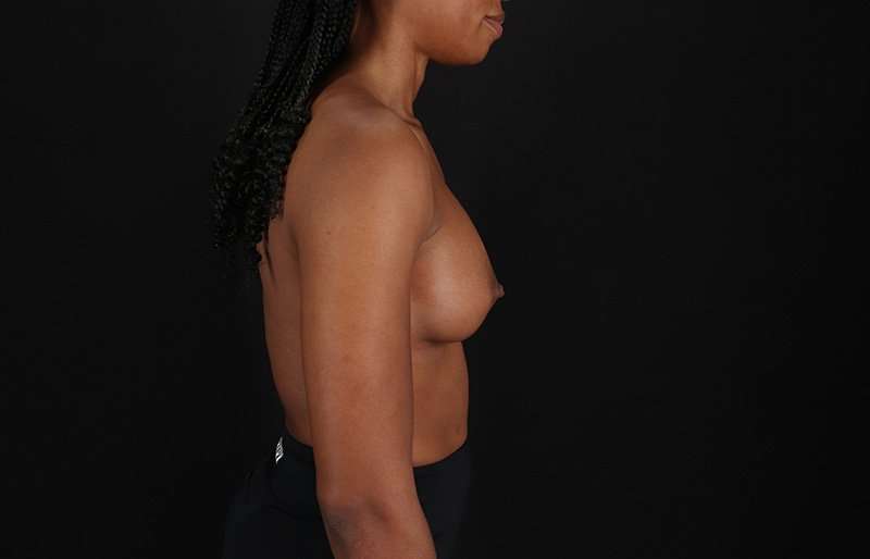 Breast Augmentation Before & After Patient #2376
