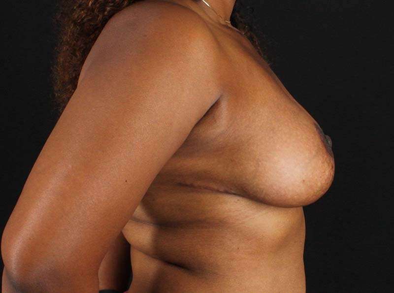 Breast Reduction Before & After Patient #2452