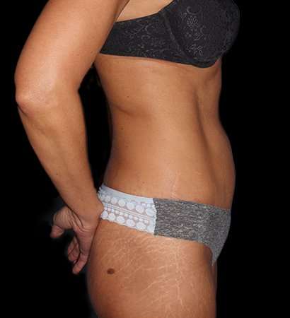 Abdominoplasty (Tummy Tuck) Before & After Patient #757