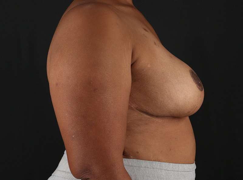 Breast Reduction Before & After Patient #2463