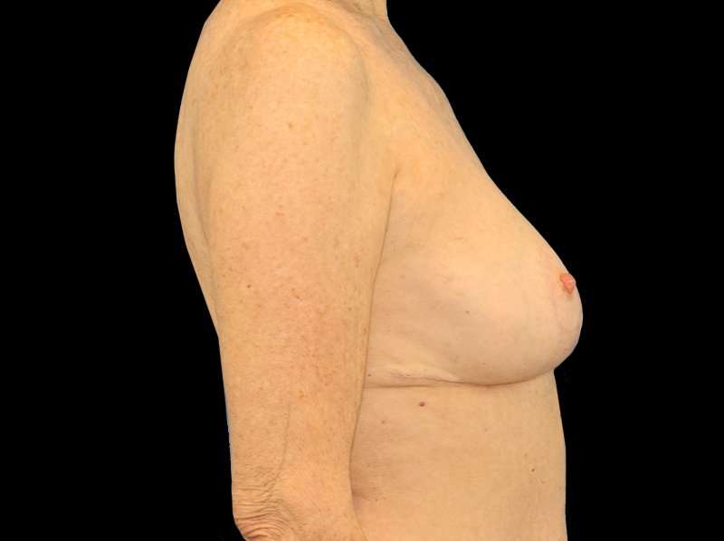 Breast Reduction Before & After Patient #2474