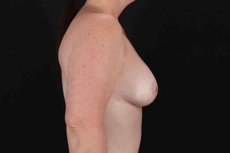 Breast Reduction Before & After Patient #2547