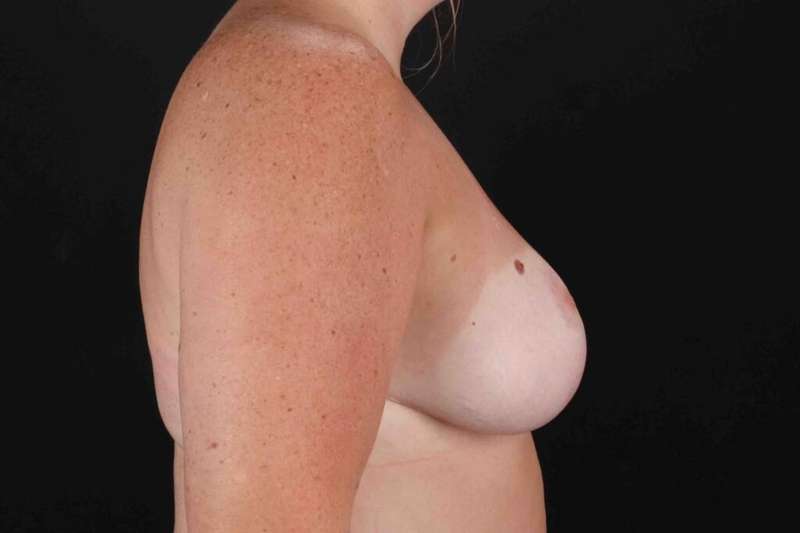 Breast Reduction Before & After Patient #2558