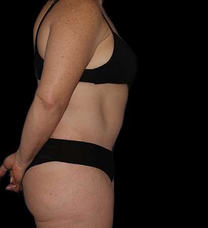 Abdominoplasty (Tummy Tuck) Before & After Patient #768