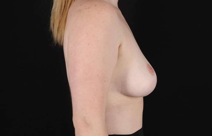 Breast Reduction Before & After Patient #2624