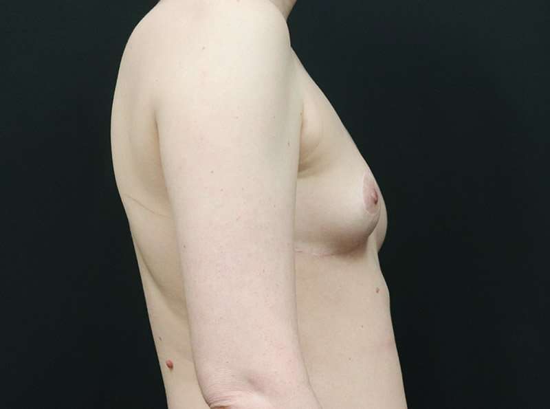Breast Reduction Before & After Patient #2635