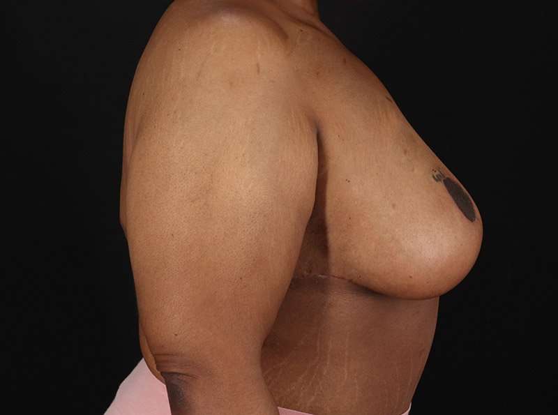 Breast Reduction Before & After Patient #2646