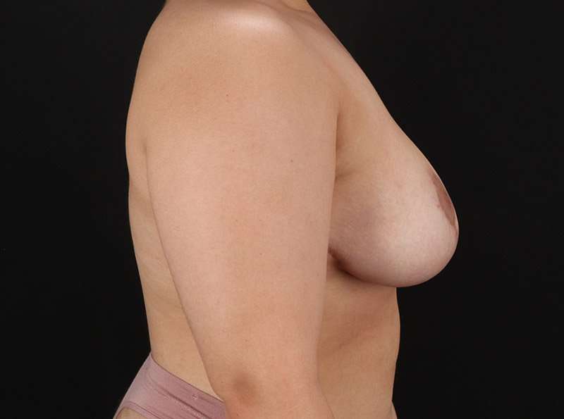 Breast Reduction Before & After Patient #2657