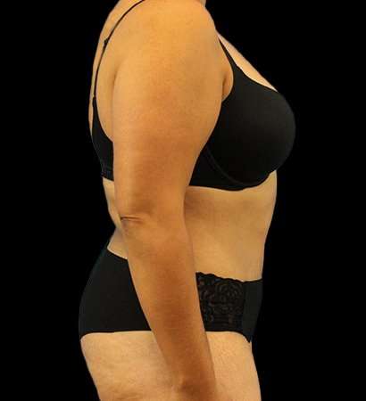 Abdominoplasty (Tummy Tuck) Before & After Patient #779