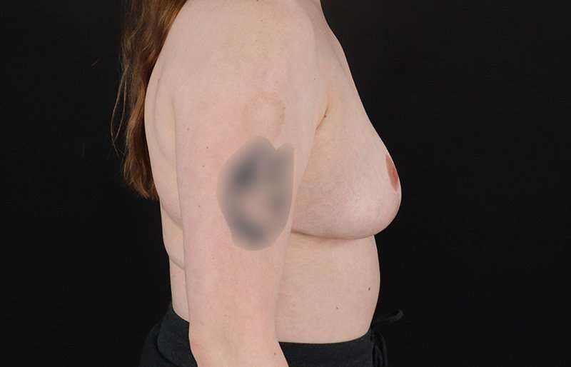 Breast Reduction Before & After Patient #2687