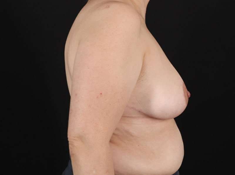 Breast Reduction Before & After Patient #2706
