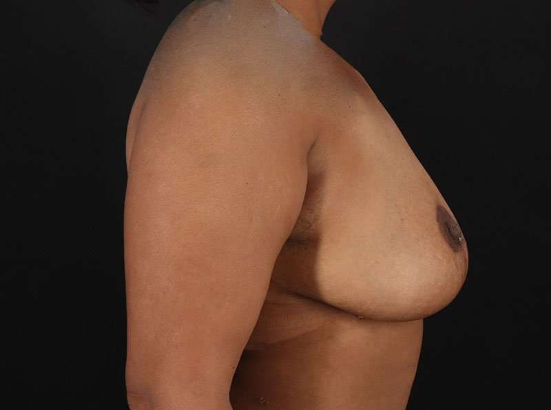 Breast Reduction Before & After Patient #2777