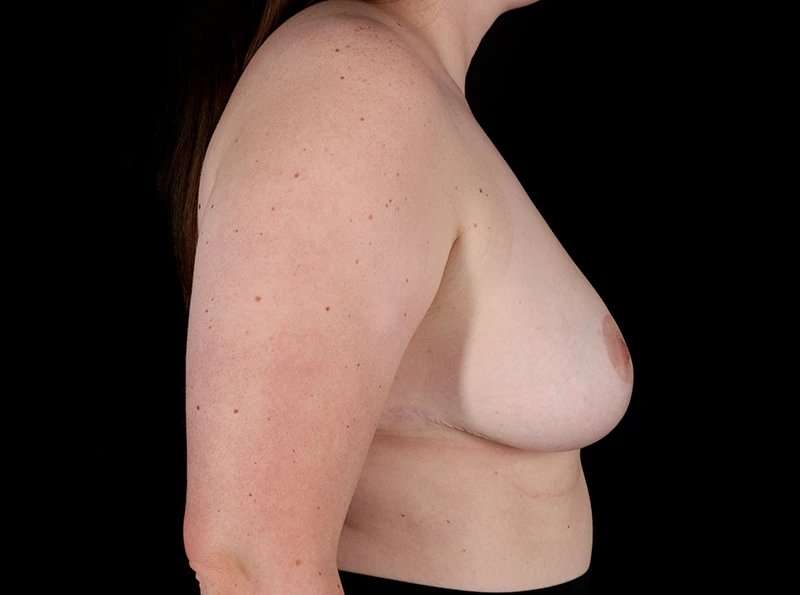 Breast Reduction Before & After Patient #2802