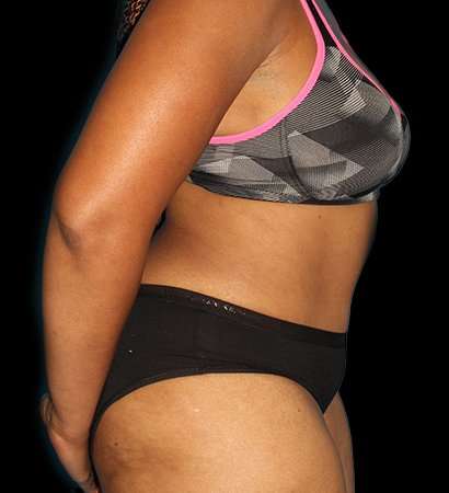 Abdominoplasty (Tummy Tuck) Before & After Patient #790