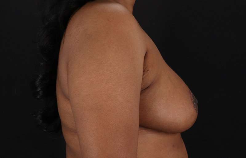 Breast Reduction Before & After Patient #2824