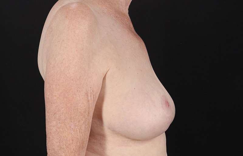 Breast Reduction Before & After Patient #2836