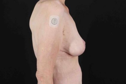 Breast Reduction Before & After Patient #2847