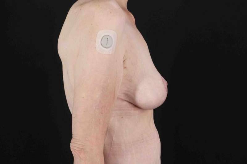 Breast Reduction Before & After Patient #2847